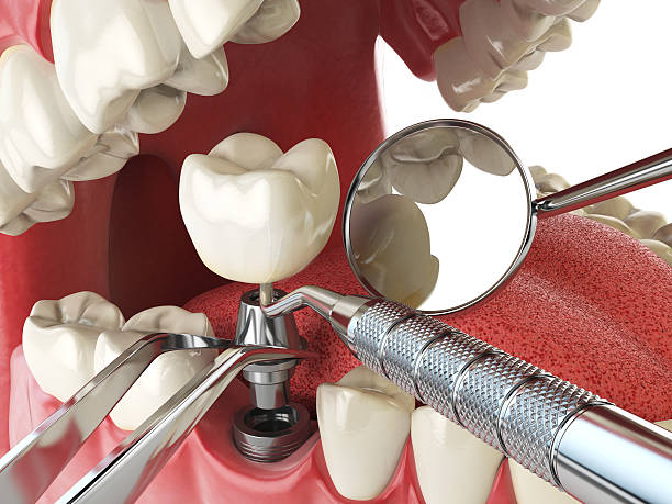 Best Emergency Dental Extractions in Dunlap, TN